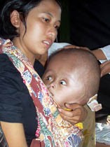 Derita Bocah Penderita Hydrocepallus di Pengungsian